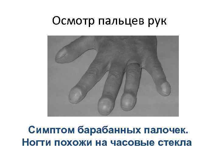 Осмотр пальцев рук Симптом барабанных палочек. Ногти похожи на часовые стекла 