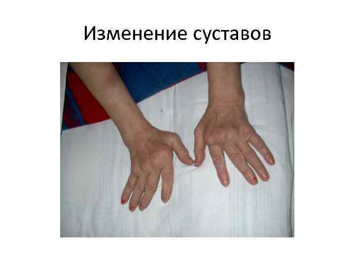 Изменение суставов 