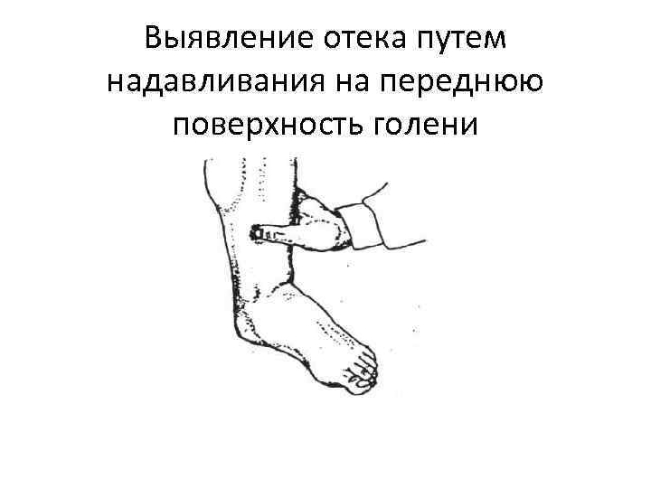 Выявление отека путем надавливания на переднюю поверхность голени 