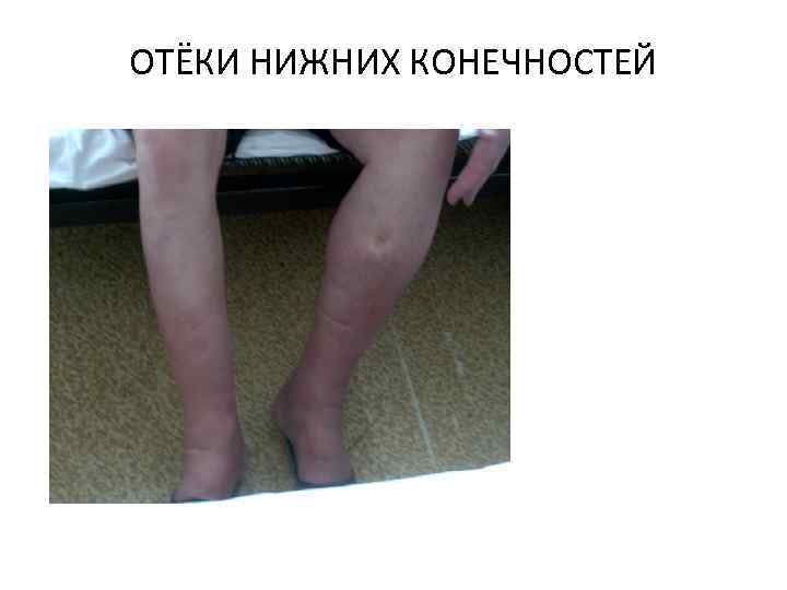 ОТЁКИ НИЖНИХ КОНЕЧНОСТЕЙ 