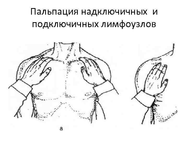 Пальпация молочной железы. Надключичные лимфоузлы Размеры в норме у взрослых. Схема расположения надключичных лимфоузлов. Подключичные и надключичные лимфатические узлы. Пальпация надключичных и подключичных лимфоузлов.