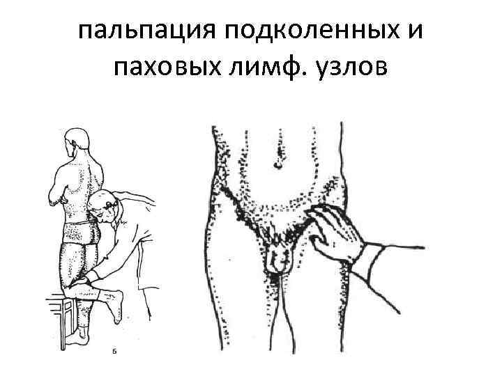 пальпация подколенных и паховых лимф. узлов 