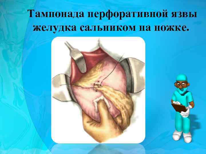 Тампонада перфоративной язвы желудка сальником на ножке. 