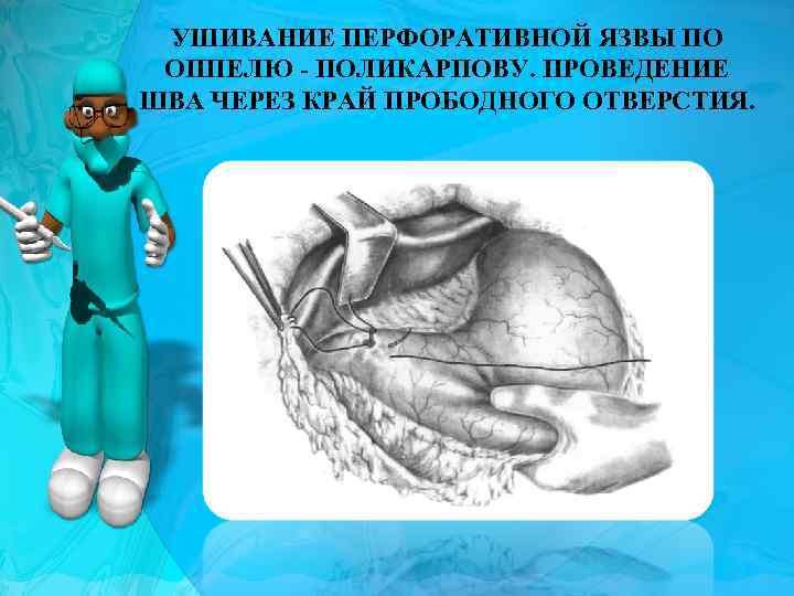 УШИВАНИЕ ПЕРФОРАТИВНОЙ ЯЗВЫ ПО ОППЕЛЮ - ПОЛИКАРПОВУ. ПРОВЕДЕНИЕ ШВА ЧЕРЕЗ КРАЙ ПРОБОДНОГО ОТВЕРСТИЯ. 