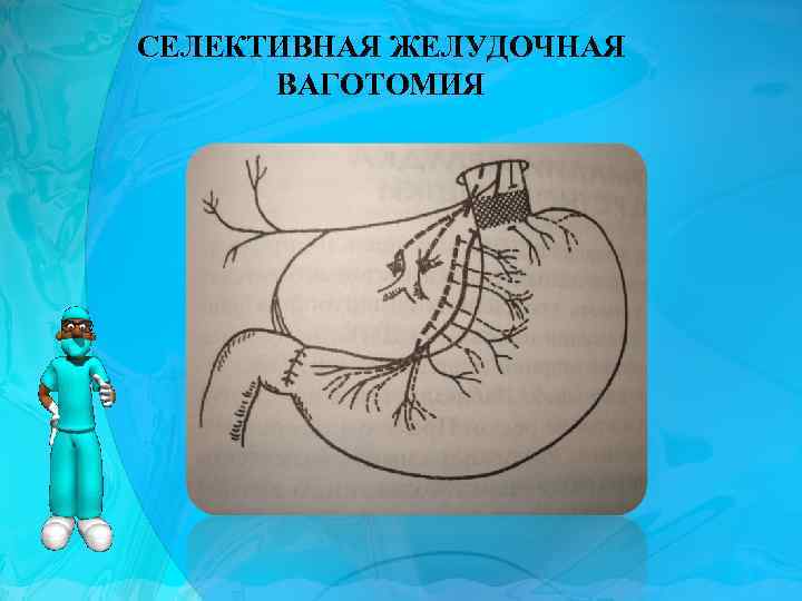 СЕЛЕКТИВНАЯ ЖЕЛУДОЧНАЯ ВАГОТОМИЯ 