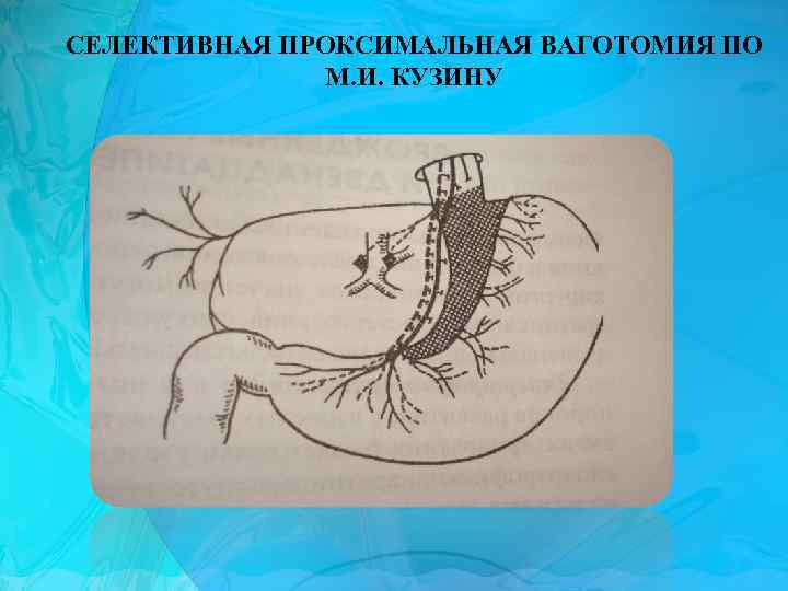 СЕЛЕКТИВНАЯ ПРОКСИМАЛЬНАЯ ВАГОТОМИЯ ПО М. И. КУЗИНУ 
