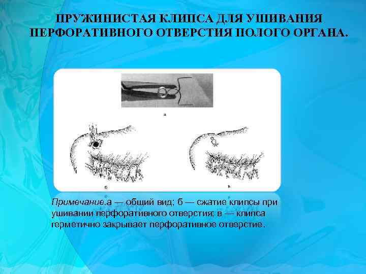 ПРУЖИНИСТАЯ КЛИПСА ДЛЯ УШИВАНИЯ ПЕРФОРАТИВНОГО ОТВЕРСТИЯ ПОЛОГО ОРГАНА. Примечание. а — общий вид; б