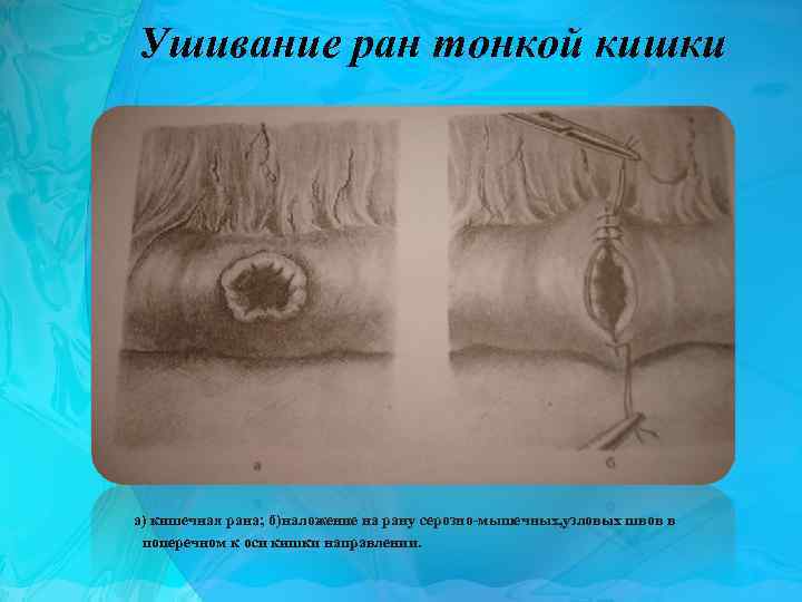 Ушивание ран тонкой кишки а) кишечная рана; б)наложение на рану серозно-мышечных, узловых швов в