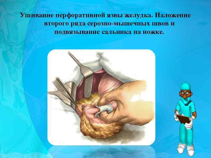 Ушивание перфоративной язвы желудка. Наложение второго ряда серозно-мышечных швов и подвязывание сальника на ножке.