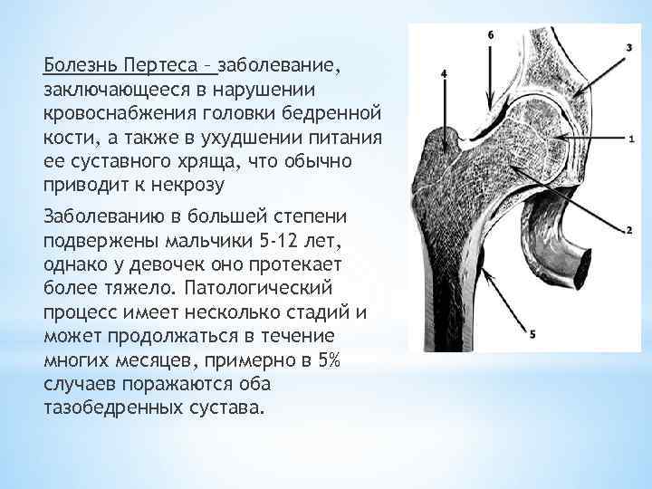 Болезнь Пертеса – заболевание, заключающееся в нарушении кровоснабжения головки бедренной кости, а также в