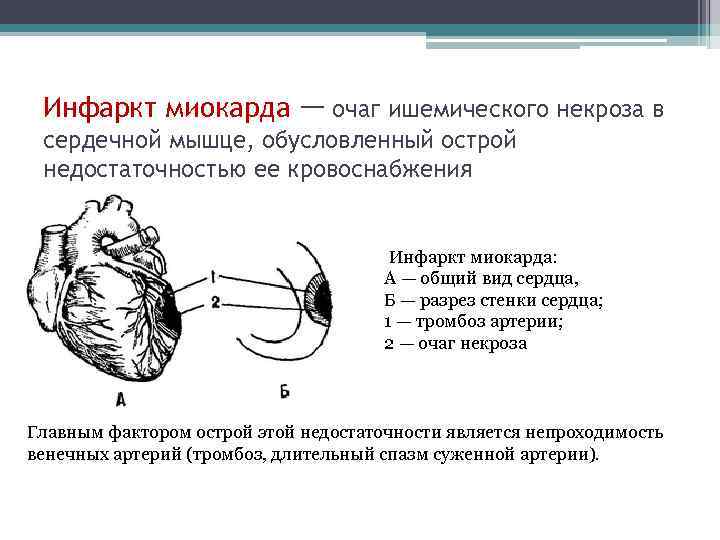 Ибс инфаркт миокарда презентация