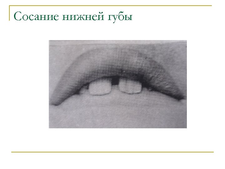 Сосание нижней губы 
