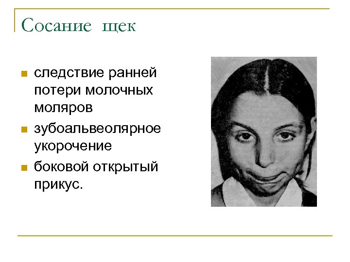 Сосание щек n n n следствие ранней потери молочных моляров зубоальвеолярное укорочение боковой открытый
