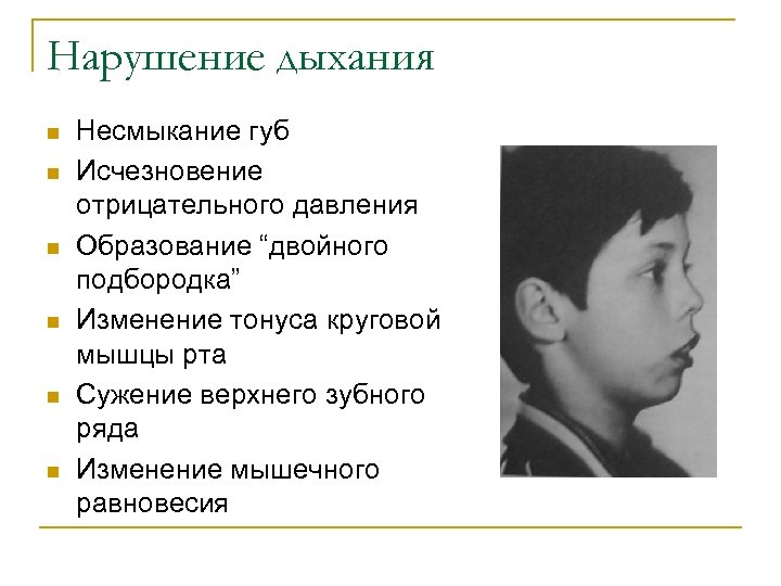 Нарушение дыхания n n n Несмыкание губ Исчезновение отрицательного давления Образование “двойного подбородка” Изменение