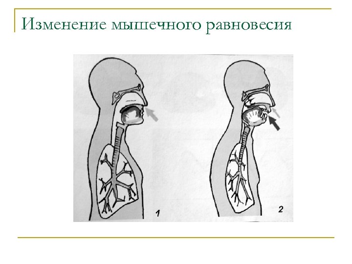 Изменение мышечного равновесия 