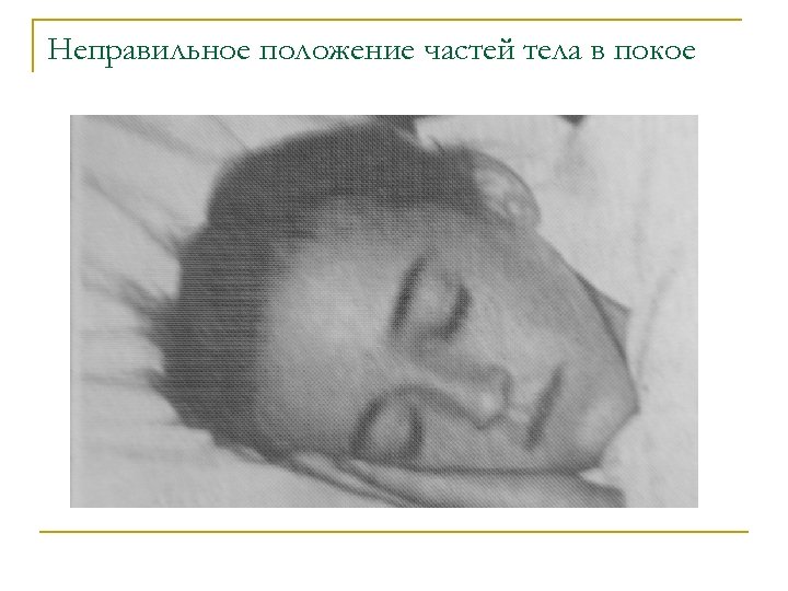 Неправильное положение частей тела в покое 
