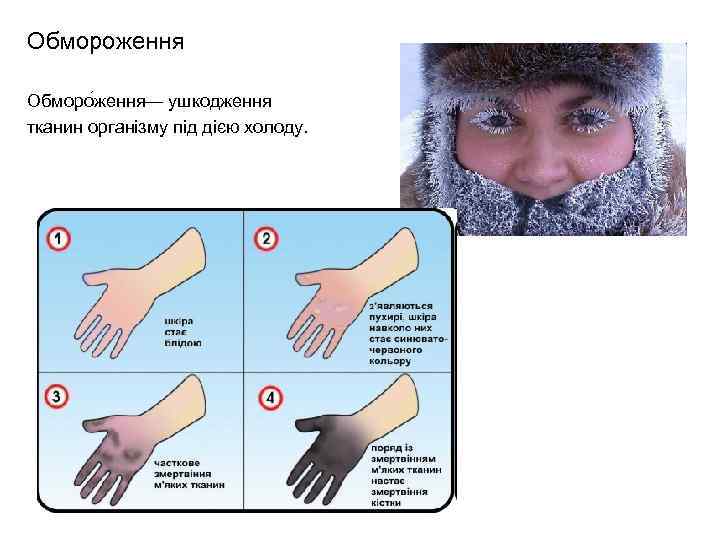 Обмороження Обморо ження— ушкодження тканин організму під дією холоду. 