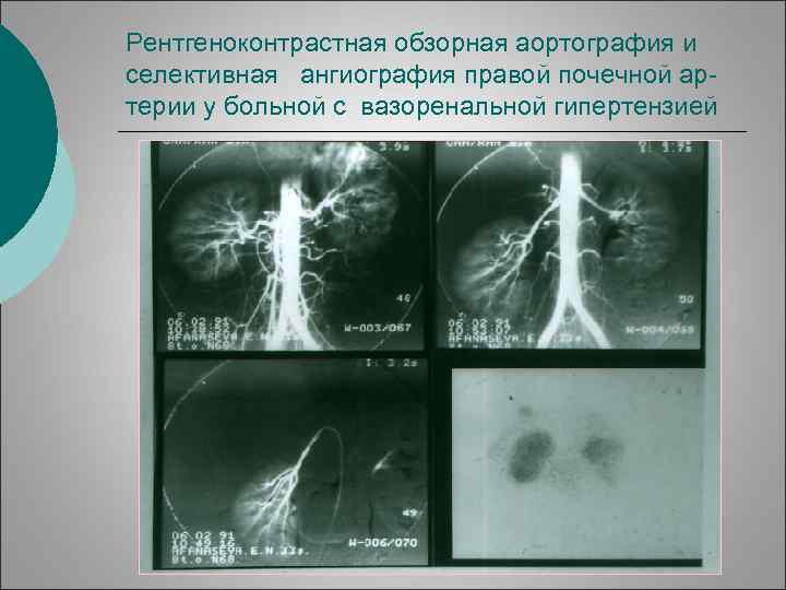 Рентгеноконтрастная обзорная аортография и селективная ангиография правой почечной артерии у больной с вазоренальной гипертензией