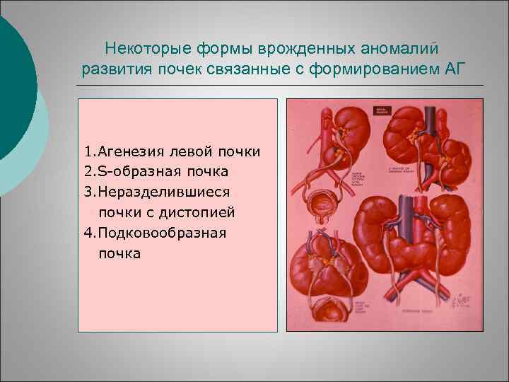 Некоторые формы врожденных аномалий развития почек связанные с формированием АГ 1. Агенезия левой почки