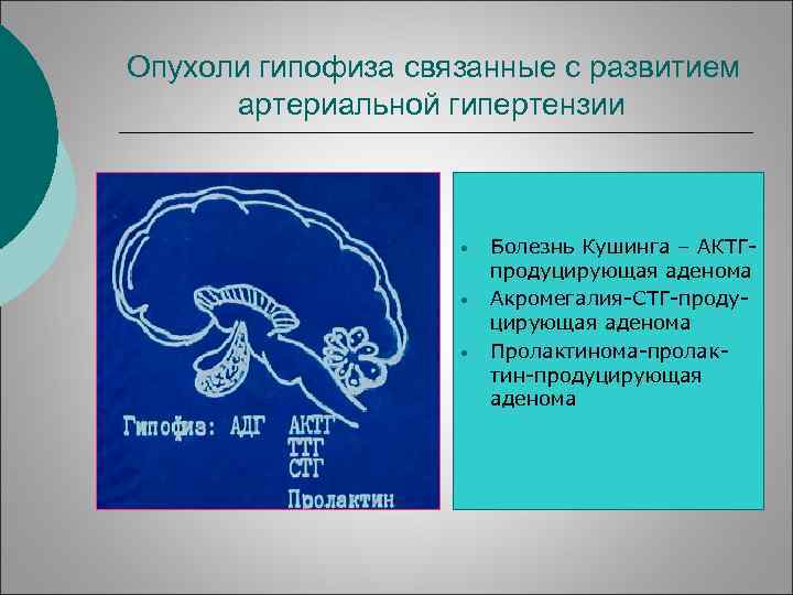 Опухоли гипофиза связанные с развитием артериальной гипертензии • • • Болезнь Кушинга – АКТГпродуцирующая