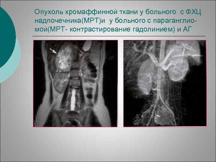 Опухоль хромаффинной ткани у больного с ФХЦ надпочечника(МРТ)и у больного с параганглиомой(МРТ- контрастирование гадолинием)