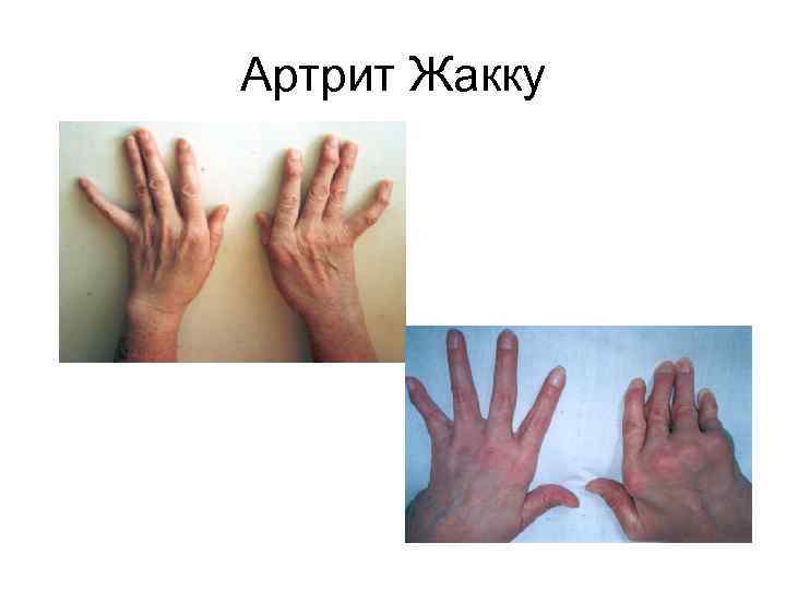 Артрит Жакку 