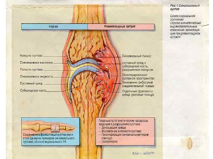 Ревматоидный артрит патанатомия презентация