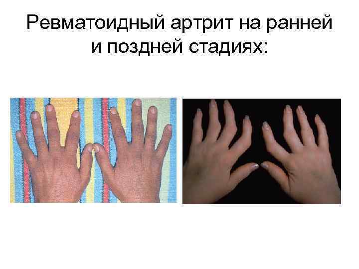 Ревматоидный артрит на ранней и поздней стадиях: 