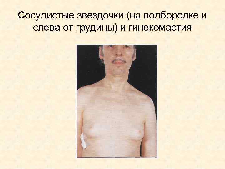 Cосудистые звездочки (на подбородке и слева от грудины) и гинекомастия 