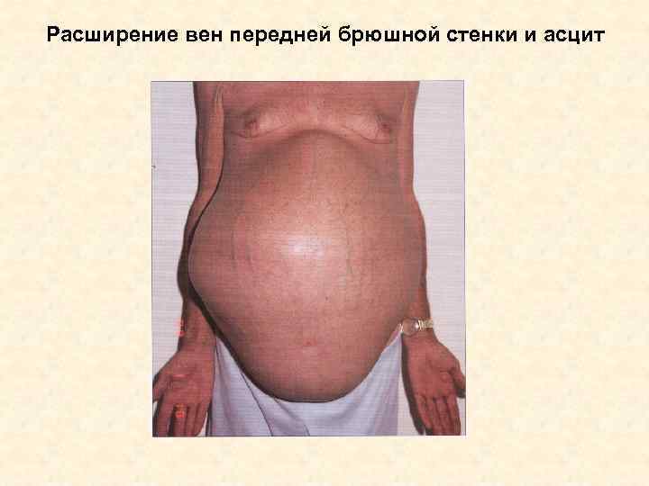 Расширение вен передней брюшной стенки и асцит 