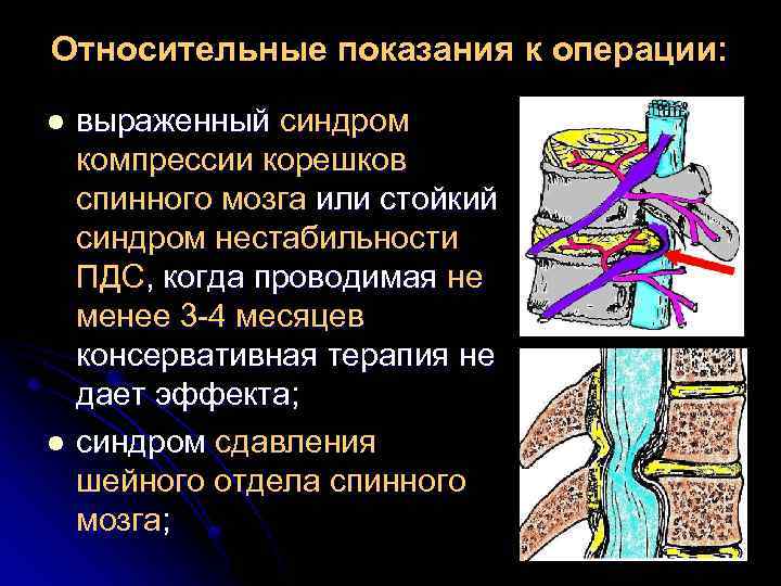 Относительные показания к операции: выраженный синдром компрессии корешков спинного мозга или стойкий синдром нестабильности