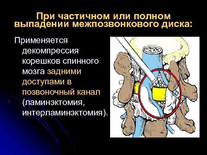 При частичном или полном выпадении межпозвонкового диска: Применяется декомпрессия корешков спинного мозга задними доступами