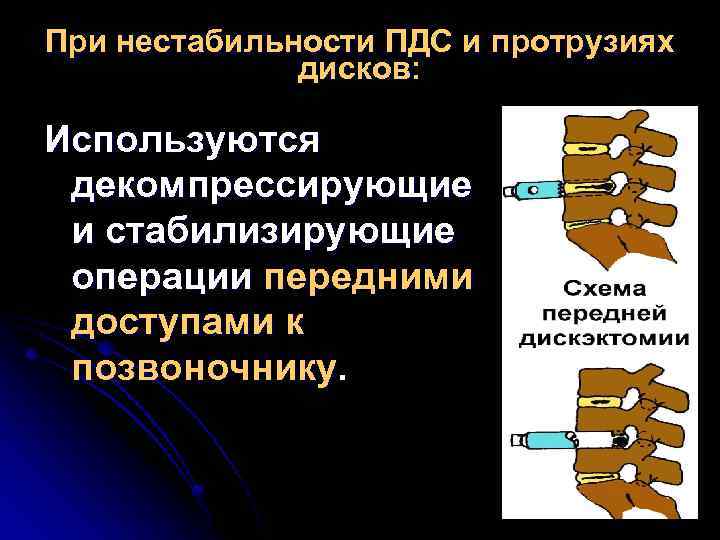 При нестабильности ПДС и протрузиях дисков: Используются декомпрессирующие и стабилизирующие операции передними доступами к