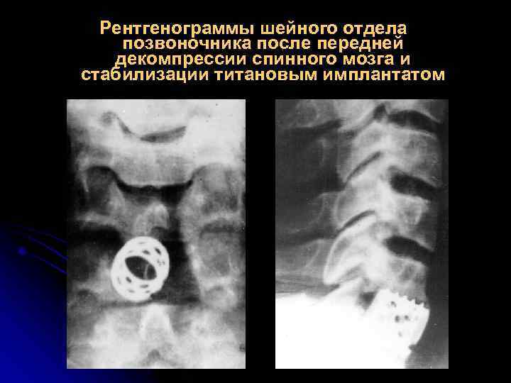 Рентгенограммы шейного отдела позвоночника после передней декомпрессии спинного мозга и стабилизации титановым имплантатом 