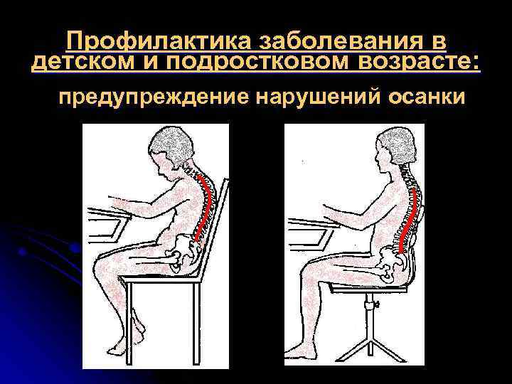 Профилактика заболевания в детском и подростковом возрасте: предупреждение нарушений осанки 