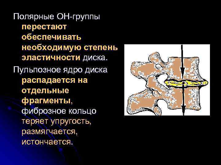 Полярные ОН-группы перестают обеспечивать необходимую степень эластичности диска. Пульпозное ядро диска распадается на отдельные