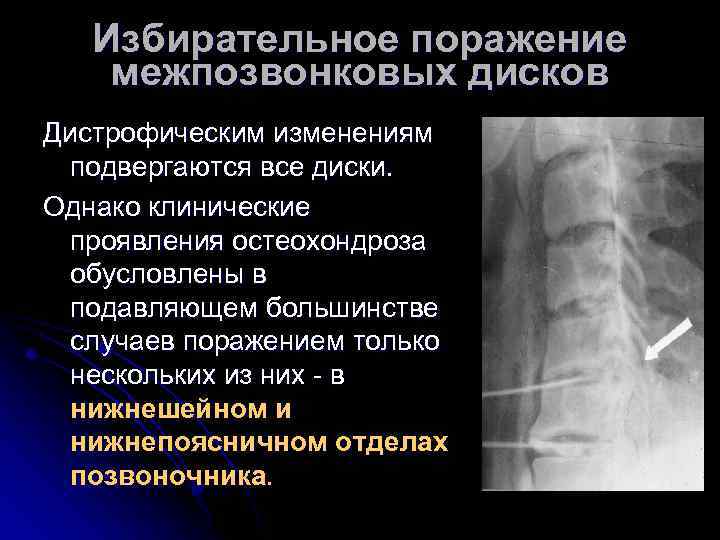 Избирательное поражение межпозвонковых дисков Дистрофическим изменениям подвергаются все диски. Однако клинические проявления остеохондроза обусловлены