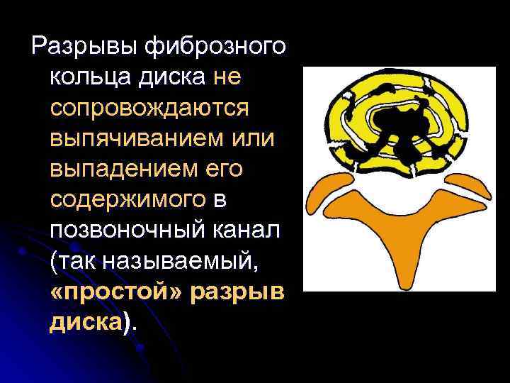 Разрывы фиброзного кольца диска не сопровождаются выпячиванием или выпадением его содержимого в позвоночный канал