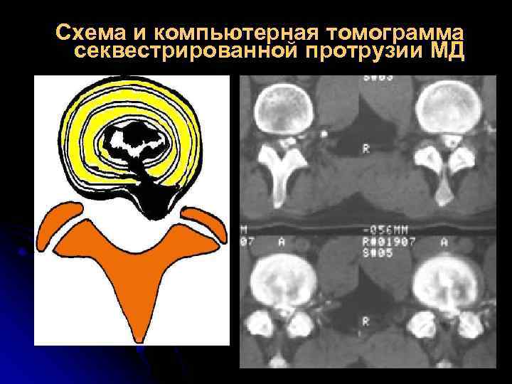 Схема и компьютерная томограмма секвестрированной протрузии МД 