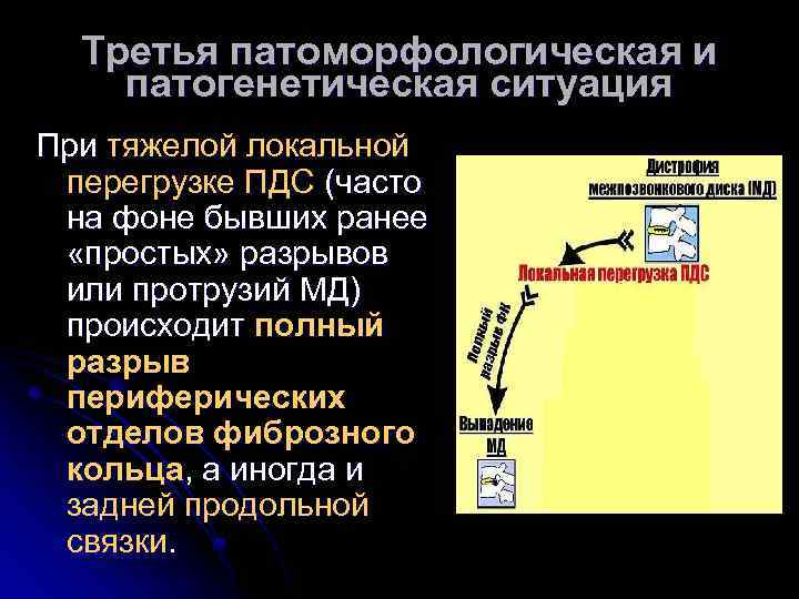 Третья патоморфологическая и патогенетическая ситуация При тяжелой локальной перегрузке ПДС (часто на фоне бывших