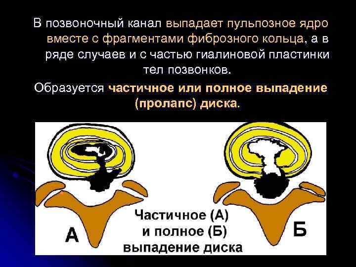 В позвоночный канал выпадает пульпозное ядро вместе с фрагментами фиброзного кольца, а в ряде