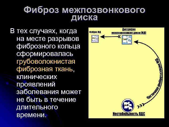 Фиброз межпозвонкового диска В тех случаях, когда на месте разрывов фиброзного кольца сформировалась грубоволокнистая