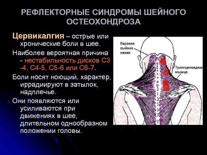 РЕФЛЕКТОРНЫЕ СИНДРОМЫ ШЕЙНОГО ОСТЕОХОНДРОЗА Цервикалгия – острые или хронические боли в шее. Наиболее вероятная