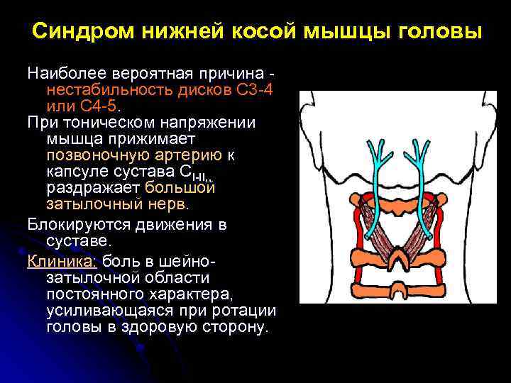 Синдром нижней косой мышцы головы Наиболее вероятная причина нестабильность дисков С 3 -4 или