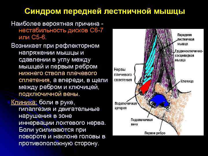 Синдром передней лестничной мышцы Наиболее вероятная причина нестабильность дисков С 6 -7 или С