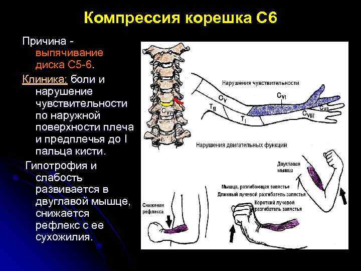 Компрессия корешка С 6 Причина выпячивание диска С 5 -6. Клиника: боли и нарушение