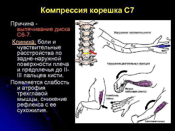 Компрессия корешка С 7 Причина выпячивание диска С 6 -7. Клиника: боли и чувствительные