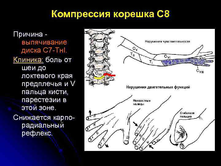 Компрессия корешка С 8 Причина выпячивание диска С 7 -Тн. I. Клиника: боль от