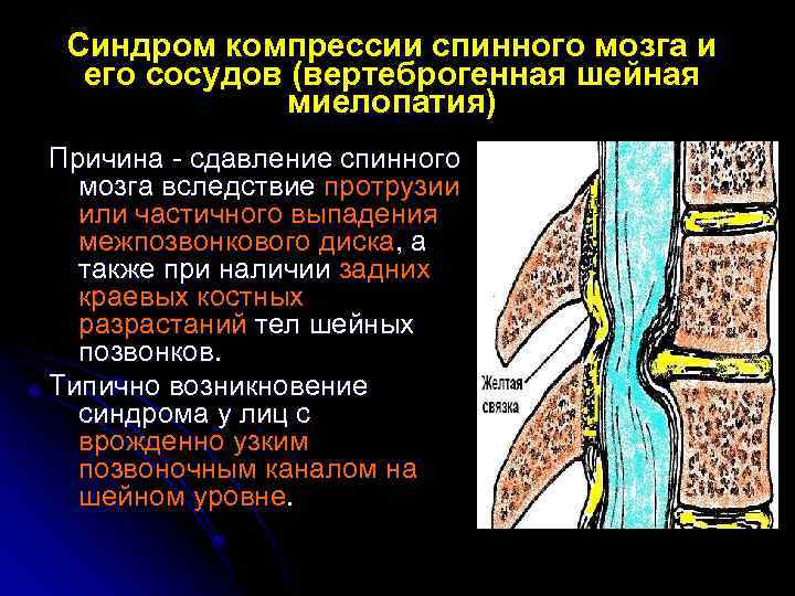 Синдром компрессии спинного мозга и его сосудов (вертеброгенная шейная миелопатия) Причина - сдавление спинного