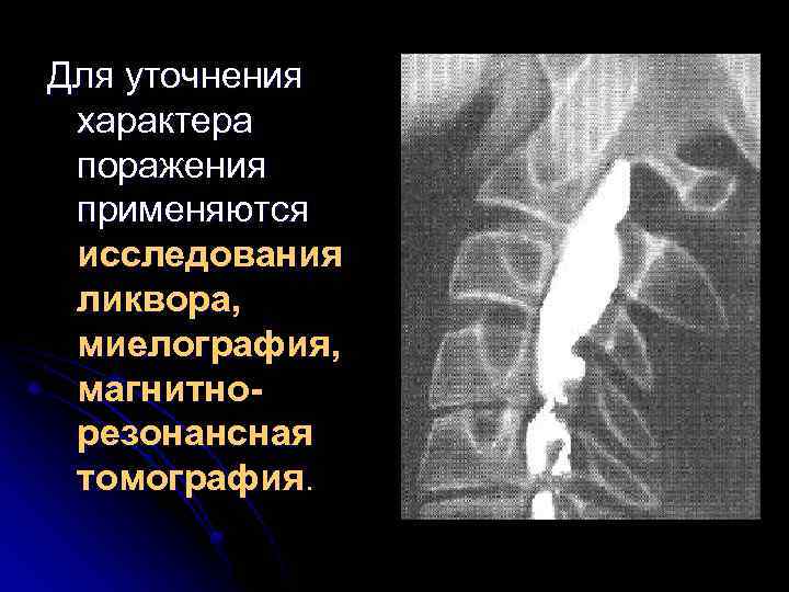 Для уточнения характера поражения применяются исследования ликвора, миелография, магнитнорезонансная томография. 